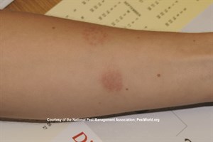 Signs of Bed Bugs: Bed Bug Skins
