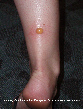 Severe Mosquito Bite Reaction Picture - Mosquito Photos from PestWorld