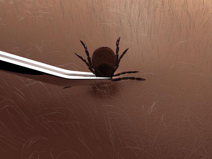 Removing a tick using tweezers