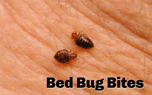Bed bug bites - Pestworld pest control