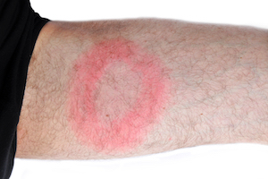 lyme disease.jpg