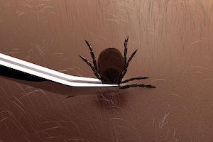 !TICK TWEEZERS.jpg