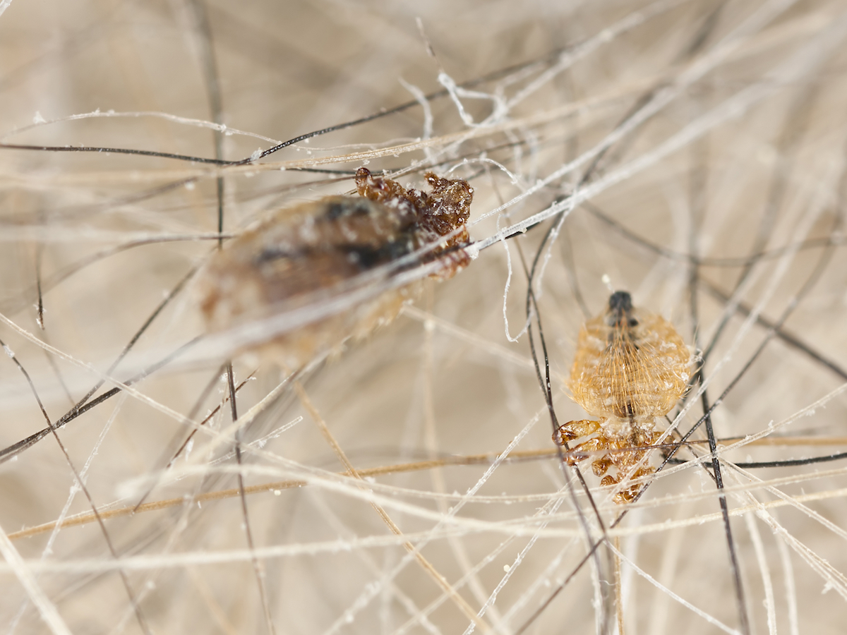 Head Lice Infestation