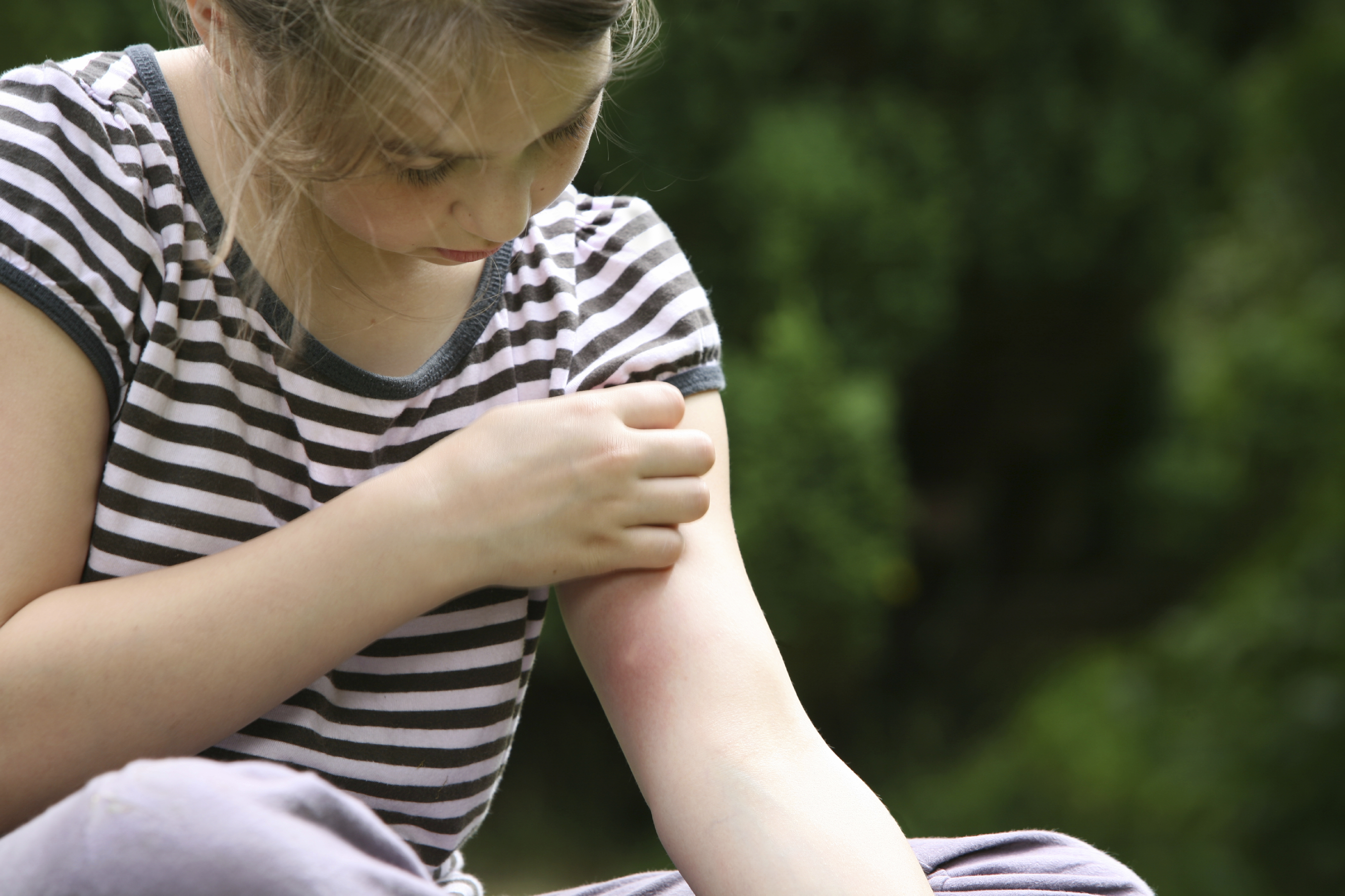 Bug Bite